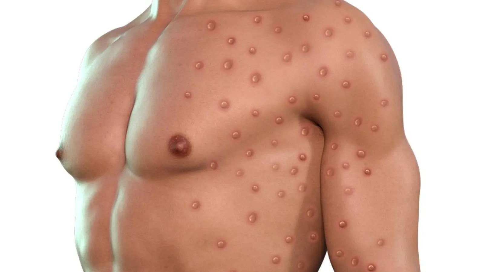 Lokalnachrichten in Bayreuth: Erster Fall von Affenpocken im Landkreis (Foto: red)